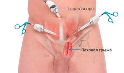 как проводится лапароскопия грыжи